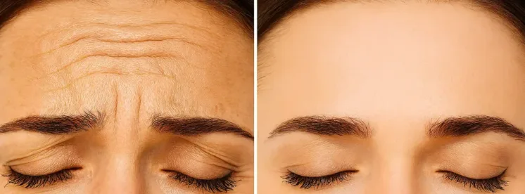 Antes y después de toxina botulínica
