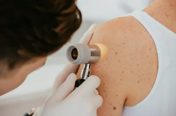Evaluación de lunares y cáncer de piel