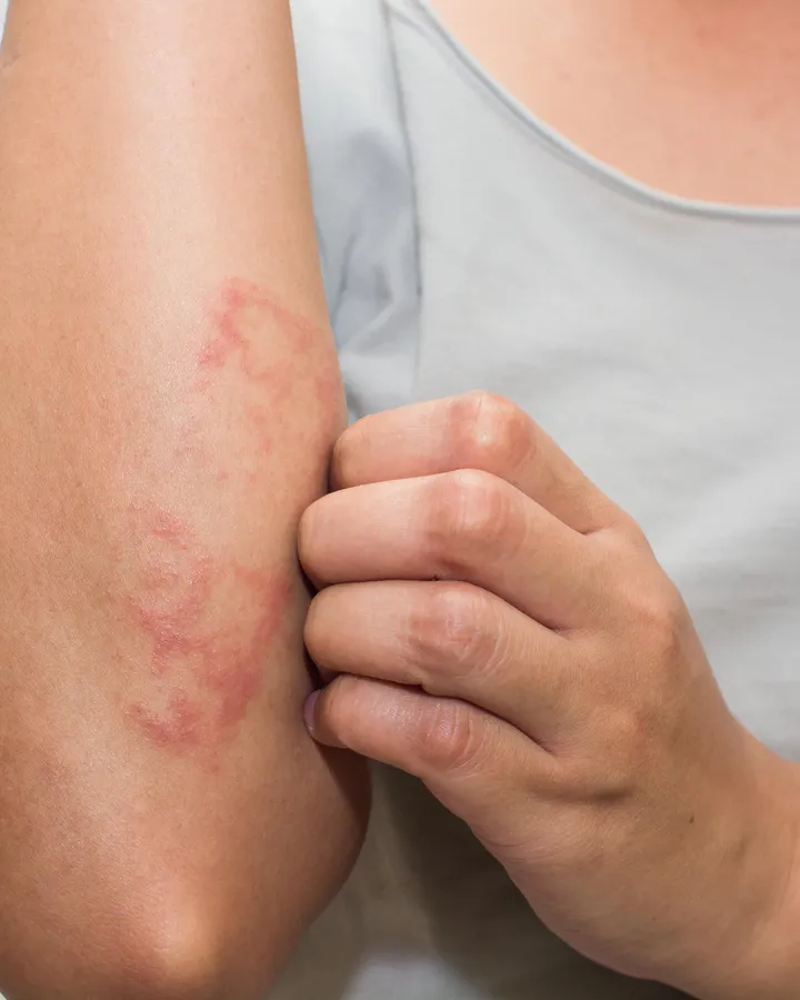 Dermatitis y alergias de la piel