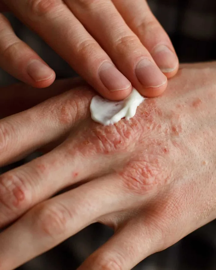 Psoriasis, vitíligo y enfermedades autoinmunes de la piel