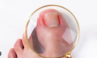 Tratamiento de uñas encarnadas