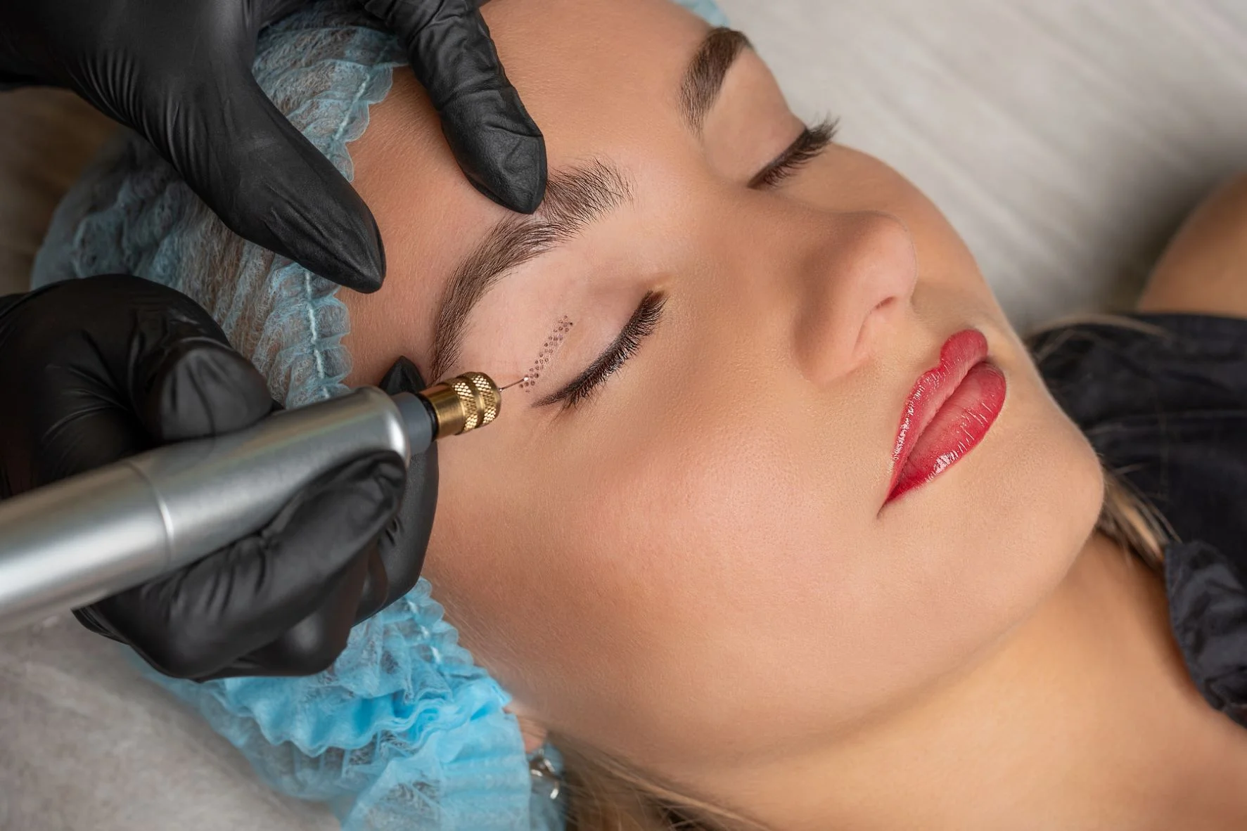 Blefaroplastia sin cirugía con Plasmed