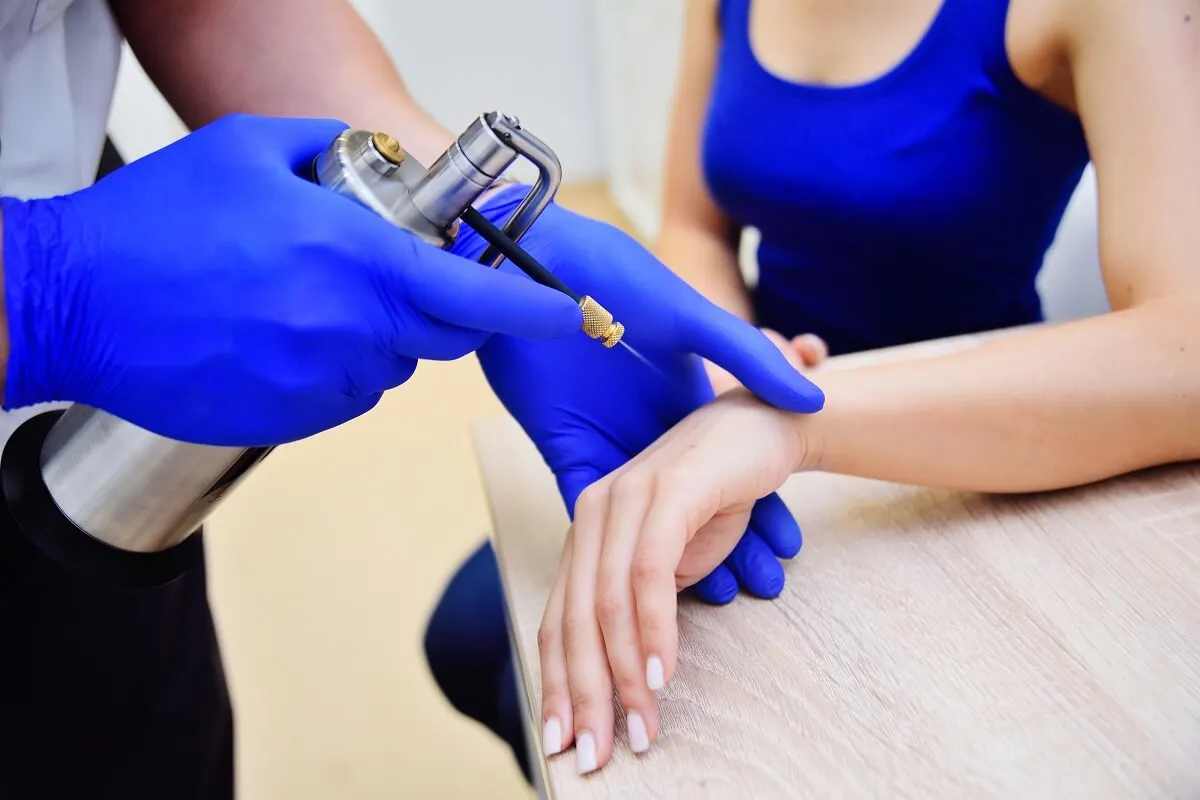 Crioterapia con nitrógeno líquido